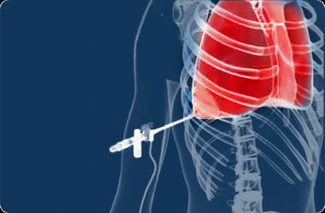 جراحی بیماریهای پلور